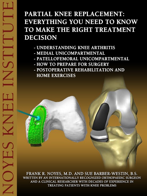 Title details for Partial Knee Replacement by Frank Noyes - Available